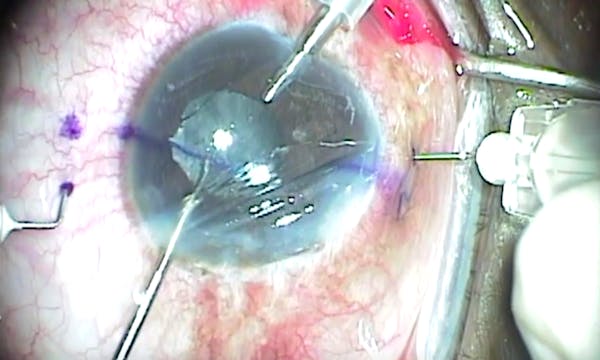 IOL Exchange With Yamane Technique thumbnail