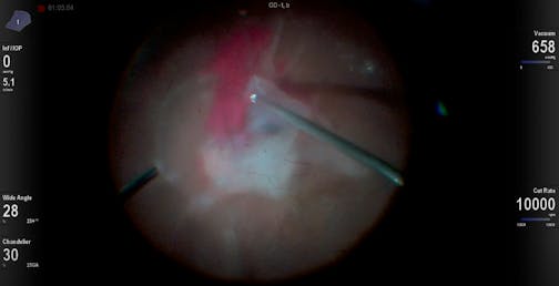 Dense Diabetic Tractional Retinal Detachment