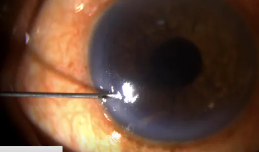 Durysta Implantation