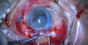 Extracapsular Cataract Extraction