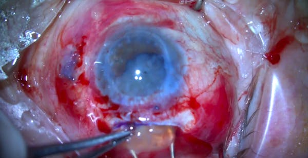 Extracapsular Cataract Extraction thumbnail