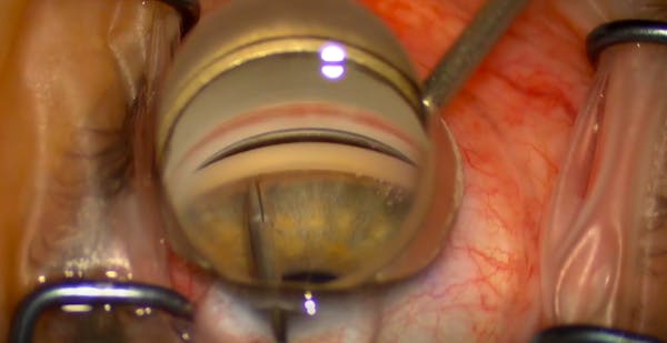 Painful Nasal Bleb thumbnail
