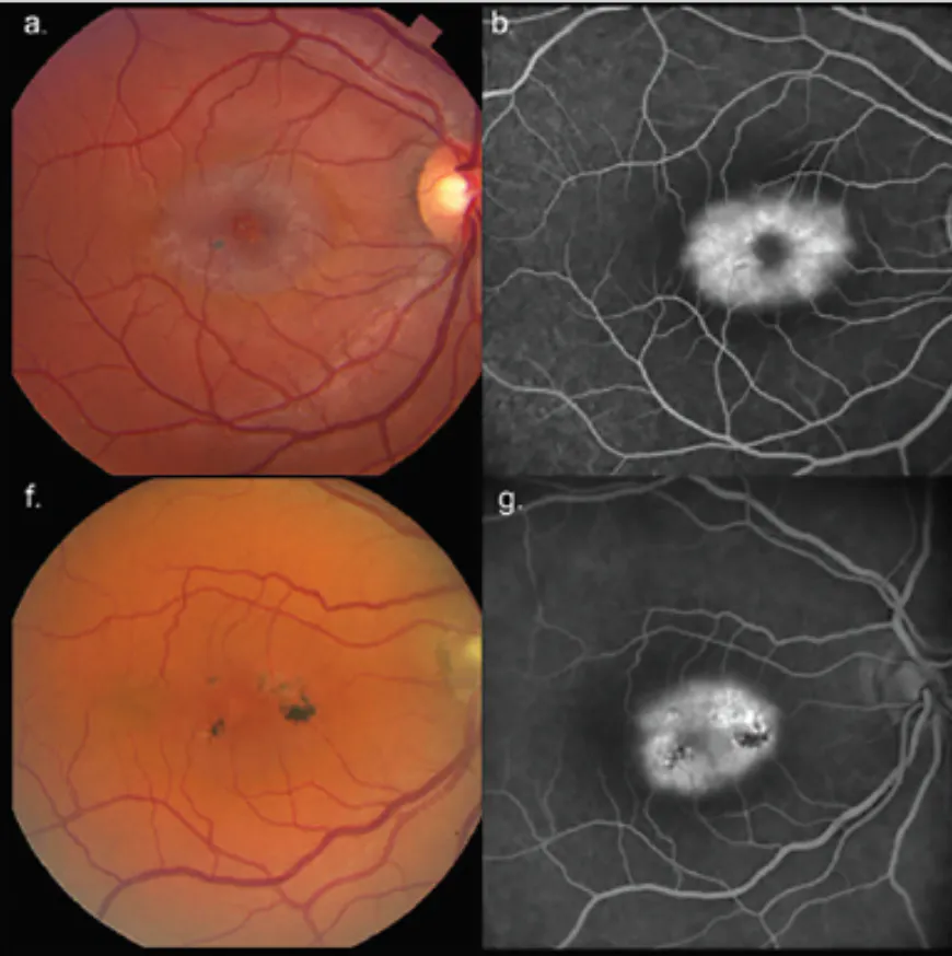Retina Around the World - Retina Today