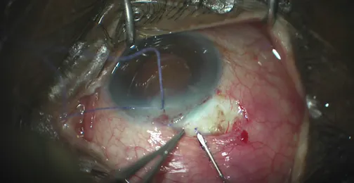 Xen Gel Stent Insertion With 27-Gauge Needle