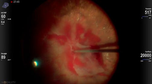 3D Tractional Retinal Detachment