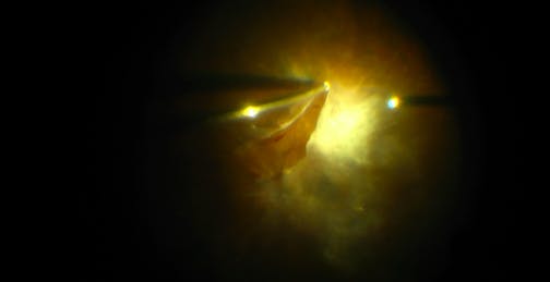 Viscodissection for Tractional Retinal Detachment