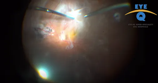 Management of Atypical Tractional Retinal Detachment