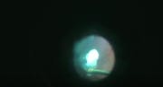 Vitesse Lensectomy