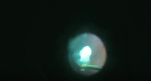 Vitesse Lensectomy