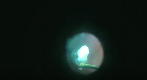 Vitesse Lensectomy thumbnail