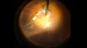 Hypersonic Vitrectomy for Macular Hole