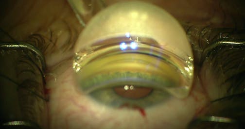 OMNI Viscodilation in a Phakic Patient