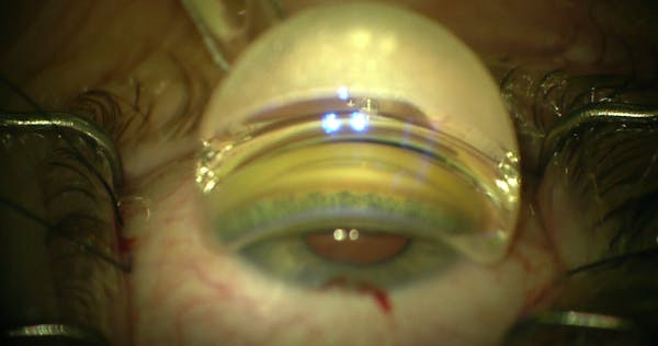 OMNI Viscodilation in a Phakic Patient thumbnail