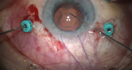 Xen Gel Stent Revision