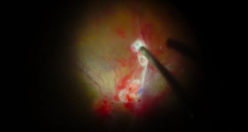 Double Peel of ERM and ILM for Severe Diabetic Tractional Retinal Detachment