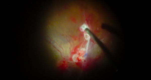 Double Peel of ERM and ILM for Severe Diabetic Tractional Retinal Detachment thumbnail