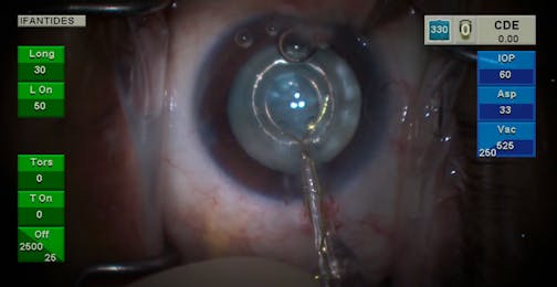 Rapidly Forming Cataract Following Vitrectomy