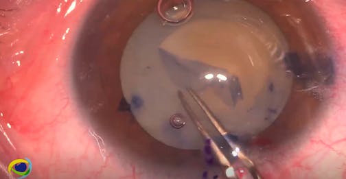 How to Avoid Capsular Block Syndrome