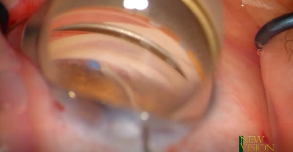 180° Ab Interno Trabeculotomy thumbnail