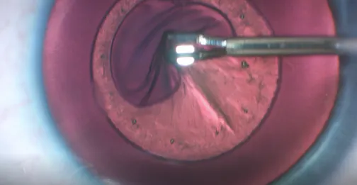 CapsuLaser Technique for Capsulorhexis Creation