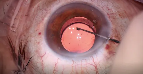 Femtis IOL Implantation