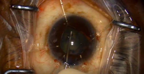 Complex Cataract and Glaucoma Surgery in Patient With Dementia