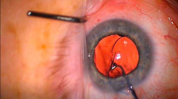 Methods of Insertion for the RxSight LAL thumbnail