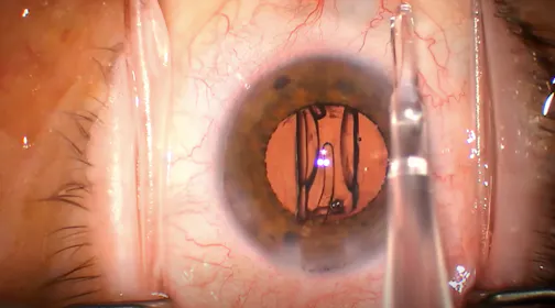 Tecnis Eyhance IOL Insertion