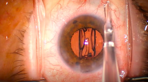 Tecnis Eyhance IOL Insertion thumbnail
