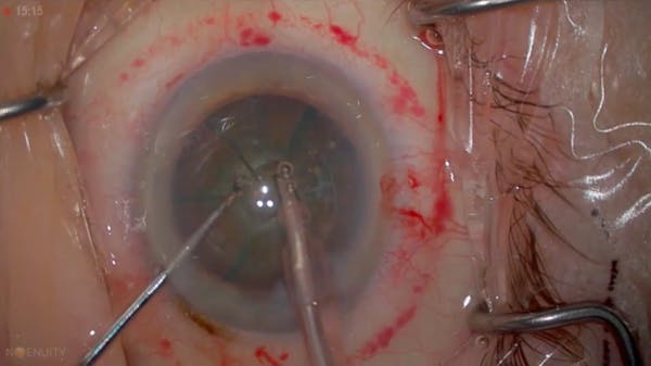 3D Digital Visualization: Femtosecond-Assisted Cataract Surgery thumbnail