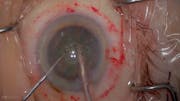 3D Digital Visualization: Femtosecond-Assisted Cataract Surgery