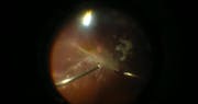 Vitrectomy for Diabetic Tractional Retinal Detachment