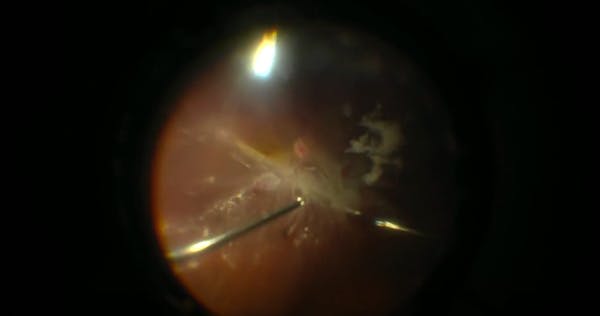 Vitrectomy for Diabetic Tractional Retinal Detachment thumbnail