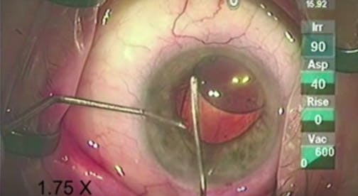 Complex Case of Pseudoexfoliation Syndrome