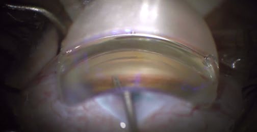 iStent inject W and Premium Cataract Surgery: Customizing Technology to Patient Desires