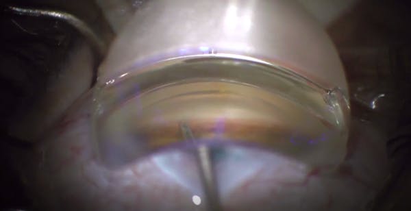 iStent inject W and Premium Cataract Surgery: Customizing Technology to Patient Desires thumbnail