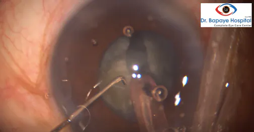 Cataract With Dense Cortical Adhesions