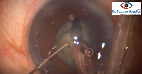 Cataract With Dense Cortical Adhesions thumbnail