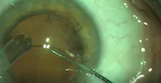 Doing Cataract Surgery in RK Land