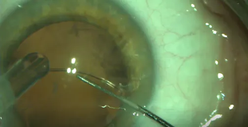 Doing Cataract Surgery in RK Land