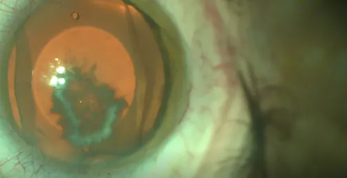 ICL Removal With Cataract: Loose Lens