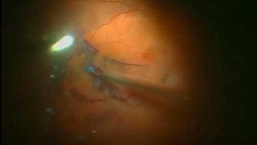 Core Vitrectomy With Epiretinal Membrane Removal