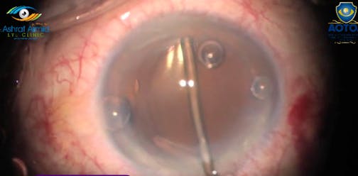 Opaque IOL Exchange Despite Open Posterior Capsule