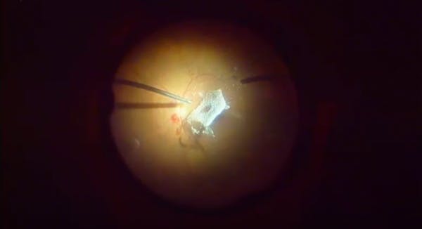 Sub-ILM Hemorrhage and an Unexpected Surprise thumbnail