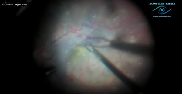 Macular Pucker ERM in Diabetic Eye Disease thumbnail