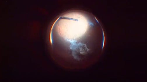 Vitreomacular Traction Resulting in Macular Hole and Retinal Detachment