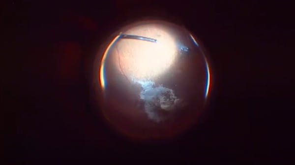 Vitreomacular Traction Resulting in Macular Hole and Retinal Detachment thumbnail
