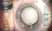 Intumescent Cataract