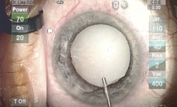 Intumescent Cataract: What is Your Paradigm? thumbnail