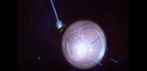 Microperforation During Scleral Buckling
